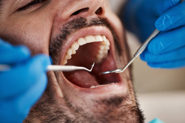Best Emergency Wisdom Teeth Removal in Suncoast Estates, FL