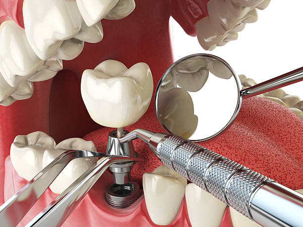 Best Emergency Tooth Extraction in Suncoast Estates, FL